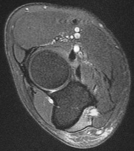 Figure 3 for case Ulnar neuritis and denervation of the flexor digitorum profundus